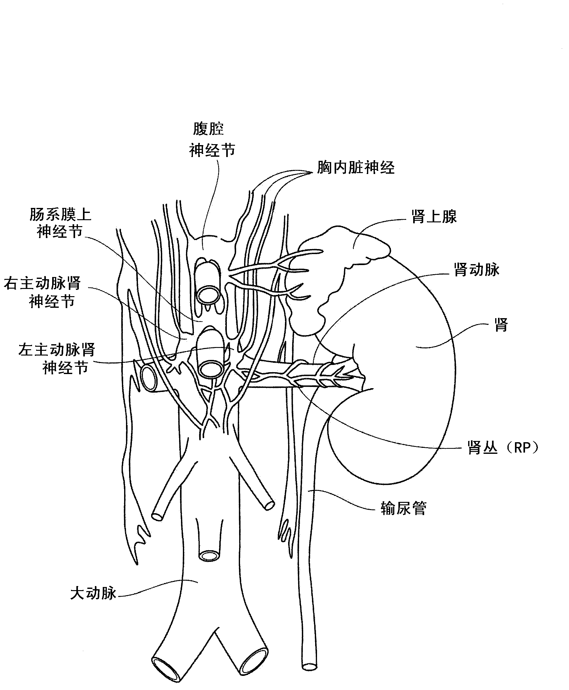 Methods and apparatus for renal neuromodulation via stereotactic radiotherapy