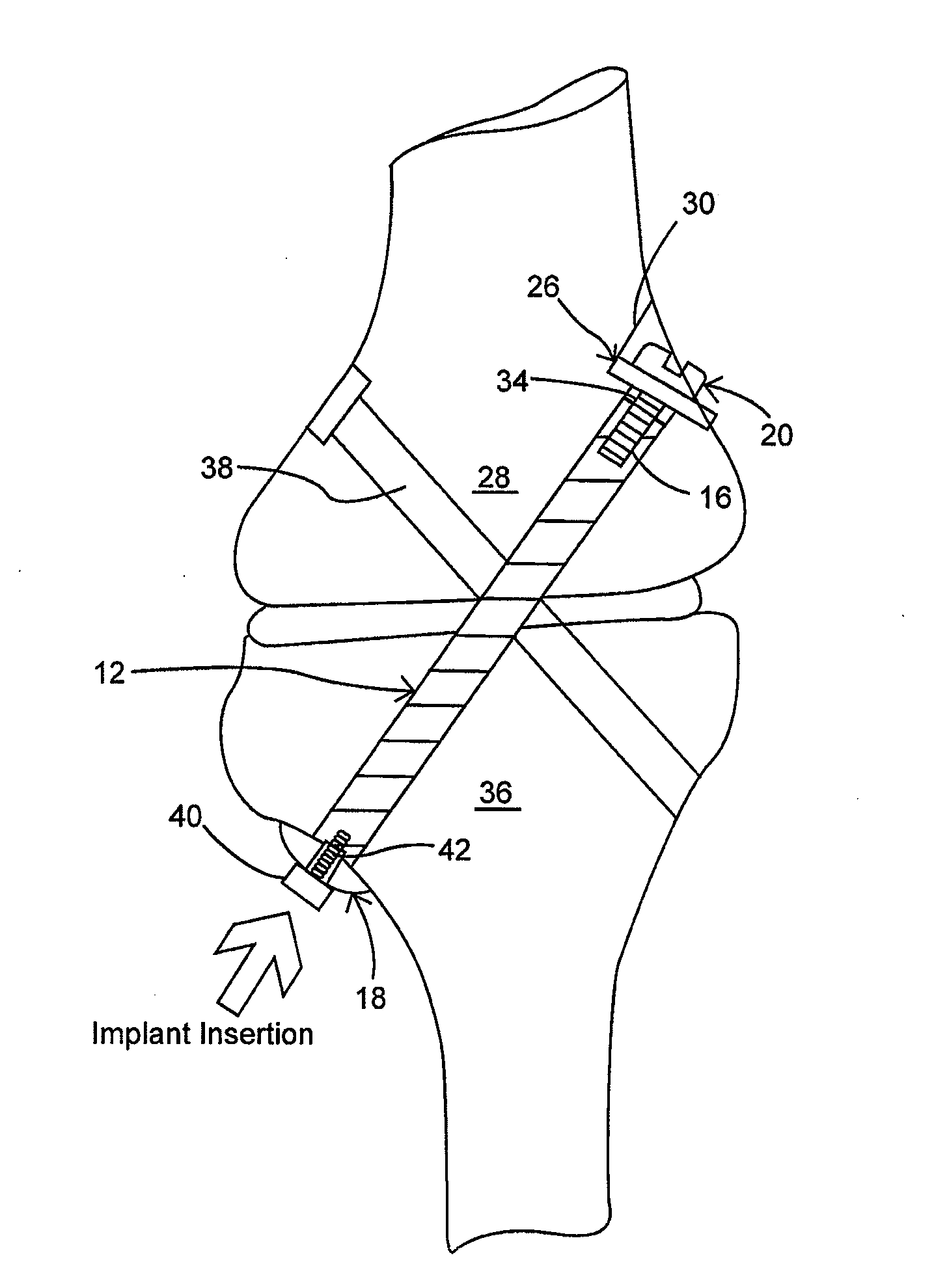 Orthopedic implant having non-circular cross section and method of use thereof