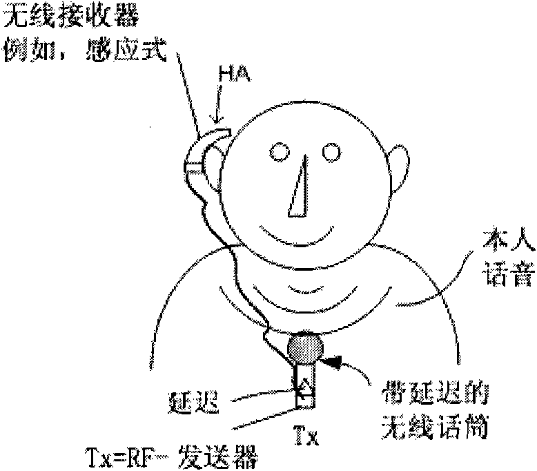 A device for treatment of stuttering and its use