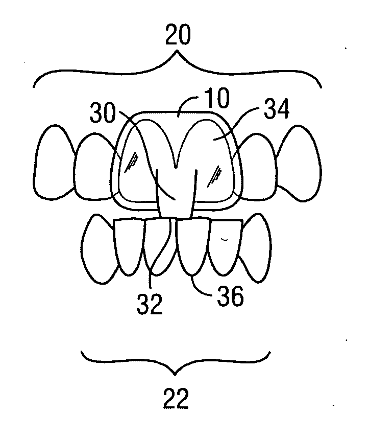 Intraoral discluder and method for relieving migraine and tension headaches and temporomandibular disorders