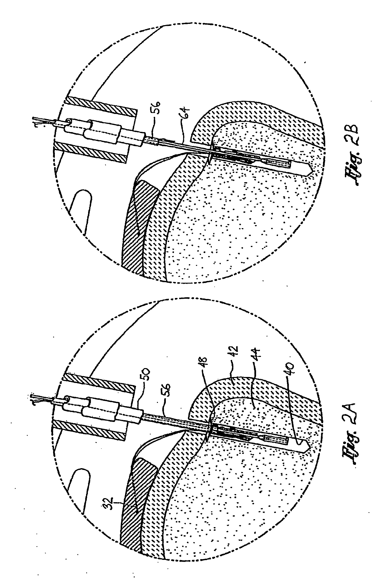 Knotless suture anchoring device having deforming section to accommodate sutures of various diameters