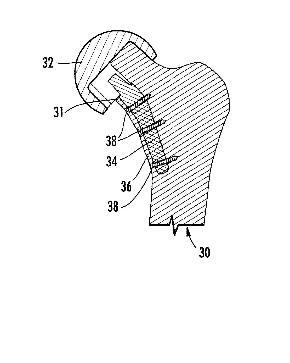 Femoral head resurfacing implant with internal plate fixation and instrumentation