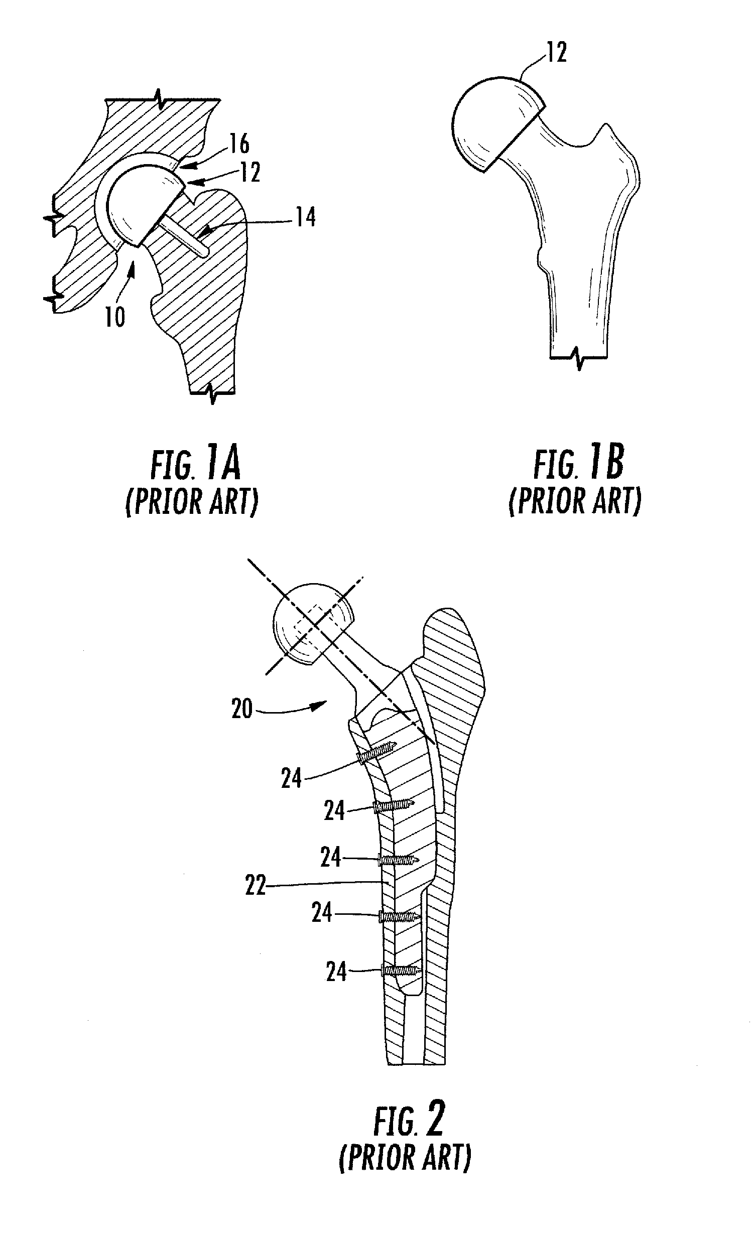 Femoral head resurfacing implant with internal plate fixation and instrumentation