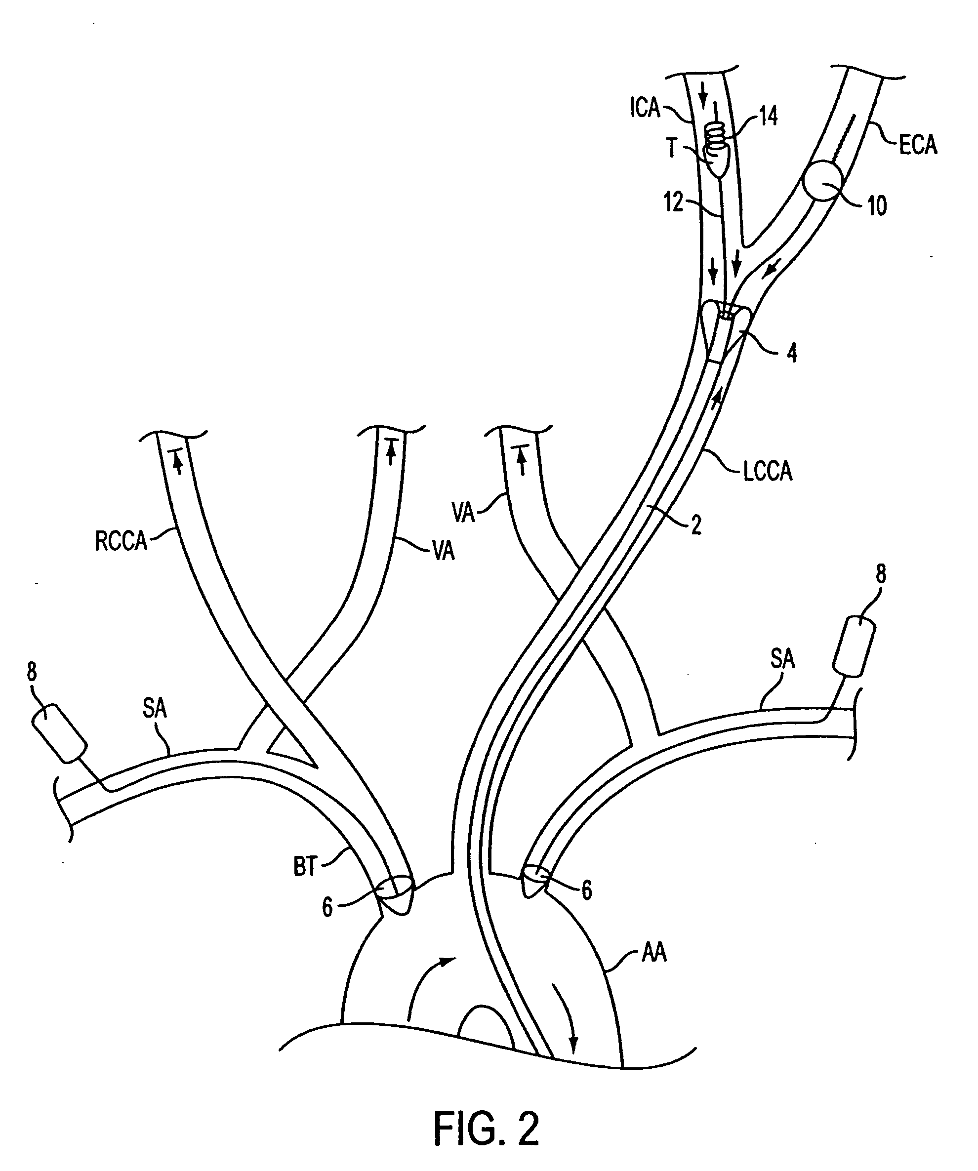Apparatus and methods for treating stroke and controlling cerebral flow characteristics