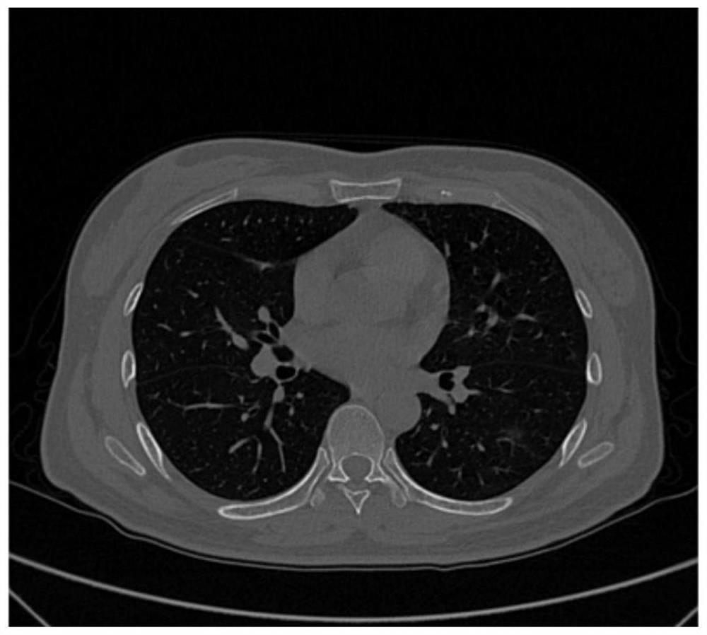 Pulmonary nodule image detection method and system based on CT image
