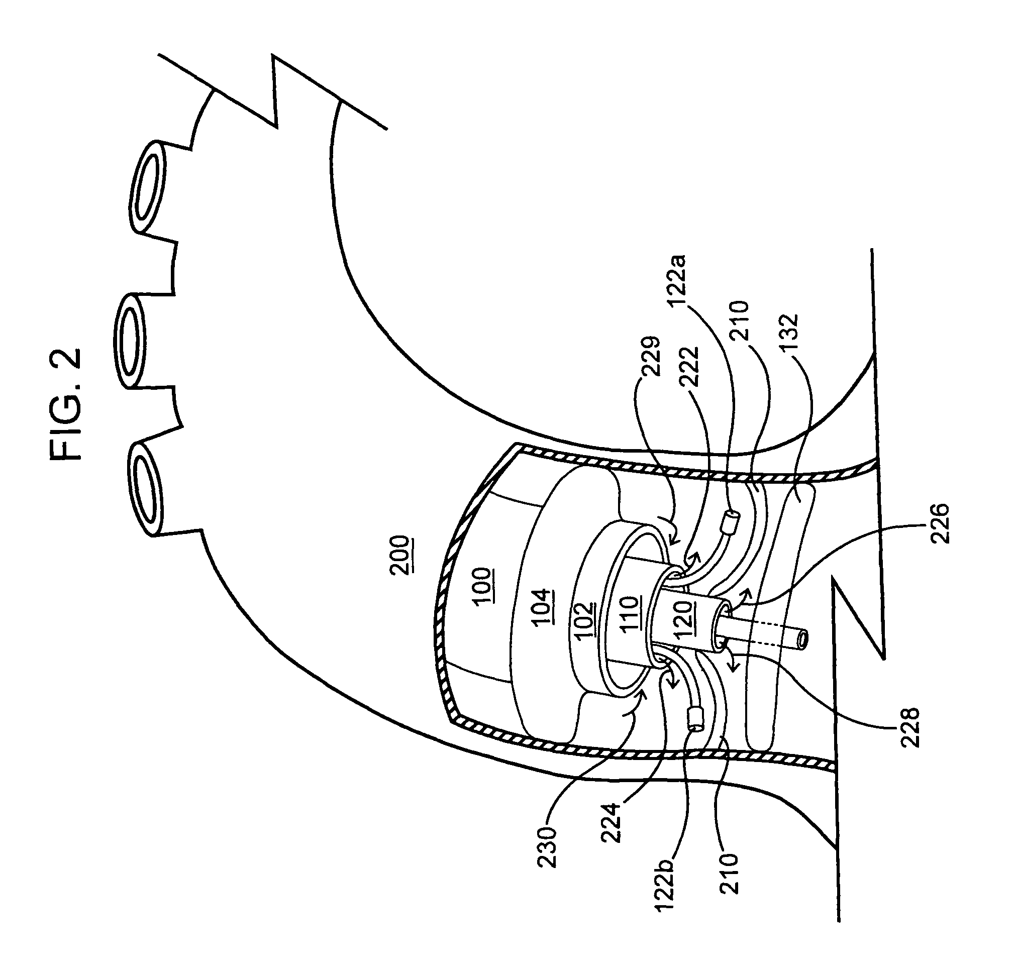 Devices and methods for treating aortic valve stenosis