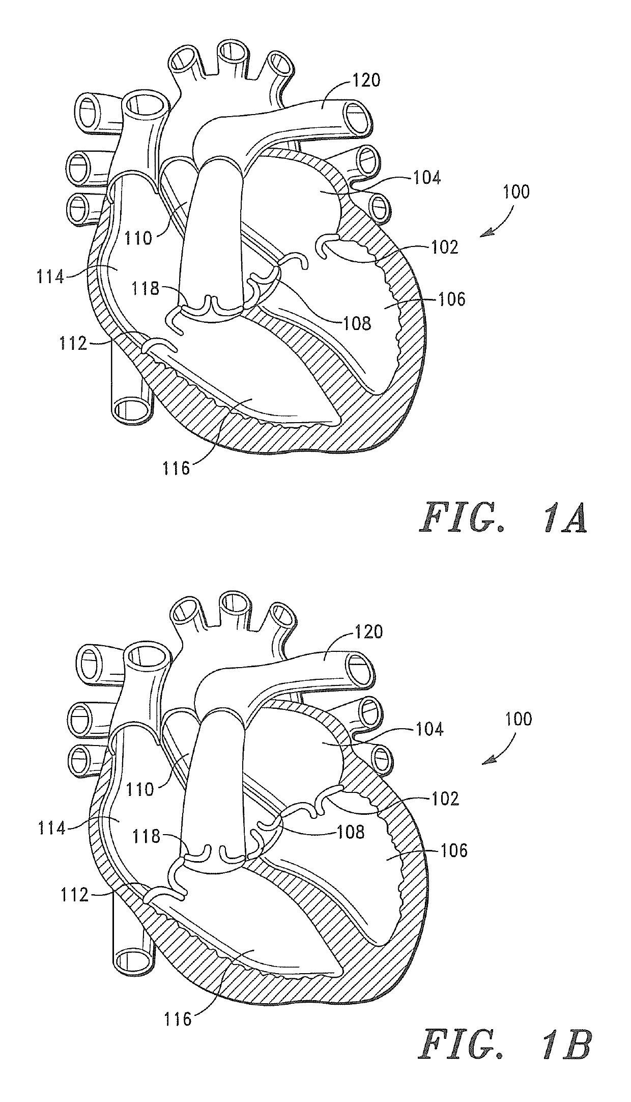 Prosthetic Tissue Valves and Methods for Replacing Native Atrioventricular Valves with Same