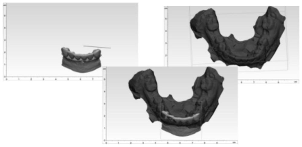 Designing and manufacturing method for personalized precise implantation of micro-implant anchorage