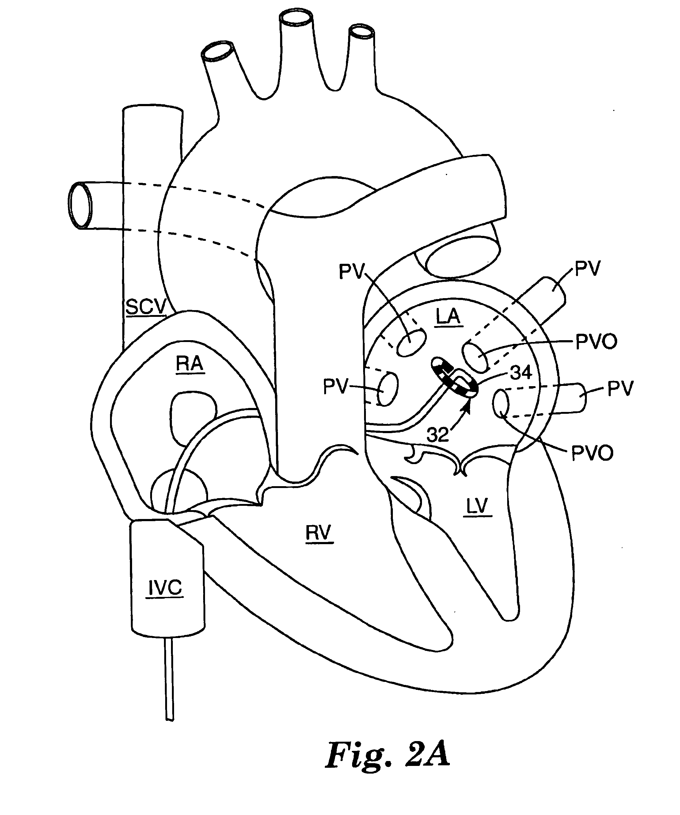 Ablation catheter and method for isolating a pulmonary vein
