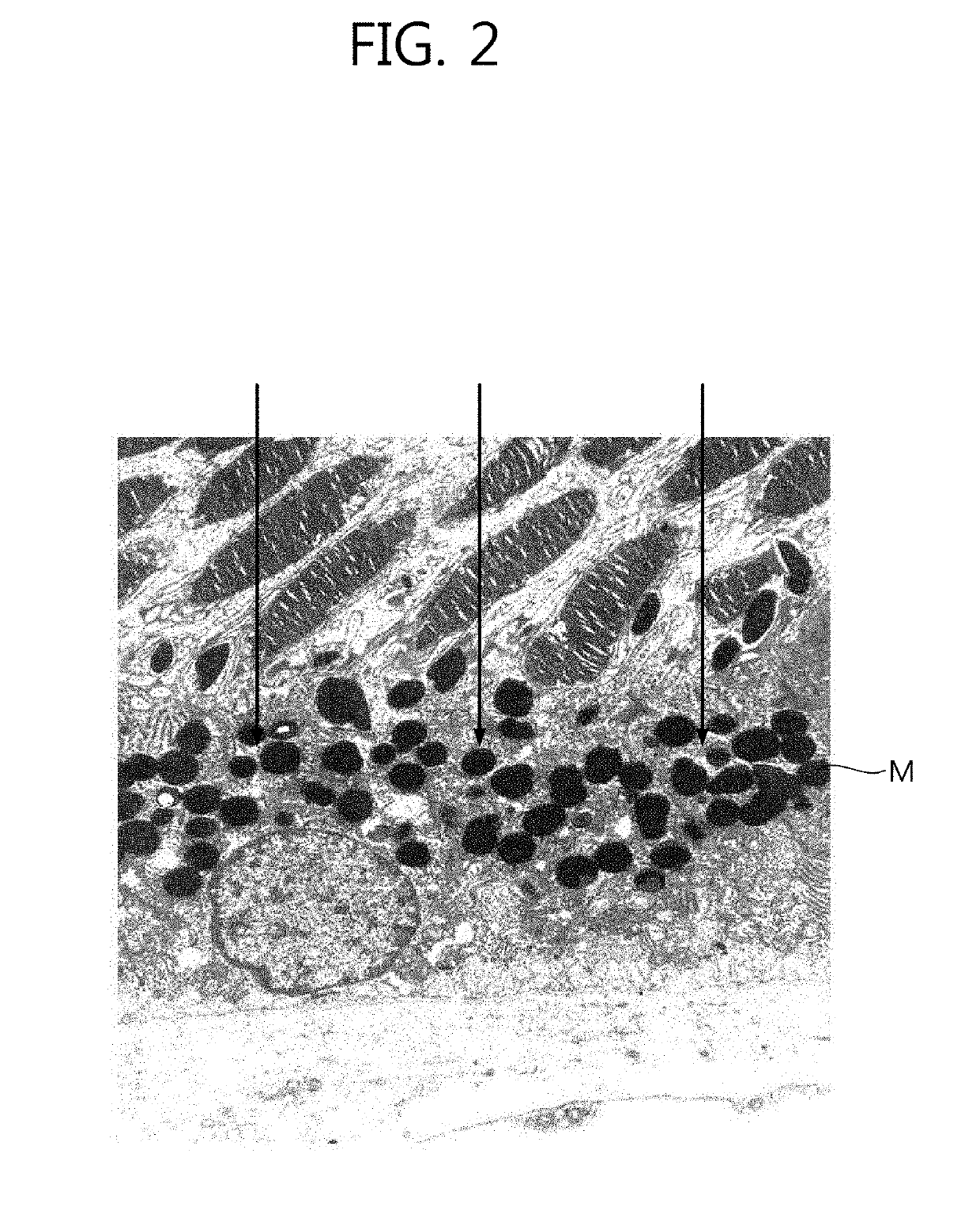 Drusen treatment method and method for controlling drusen treatment device