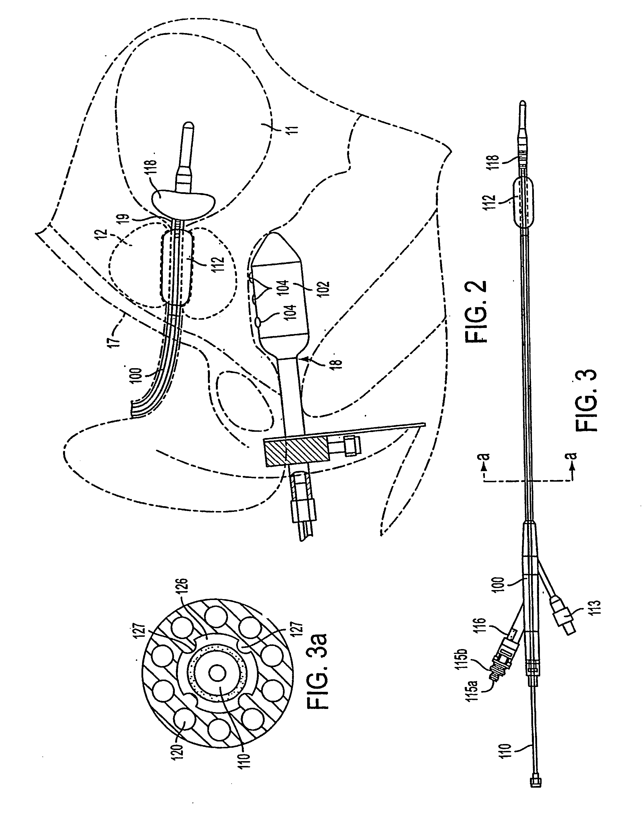 Method and apparatus treating tissue adjacent a bodily conduit with thermocompression and drugs