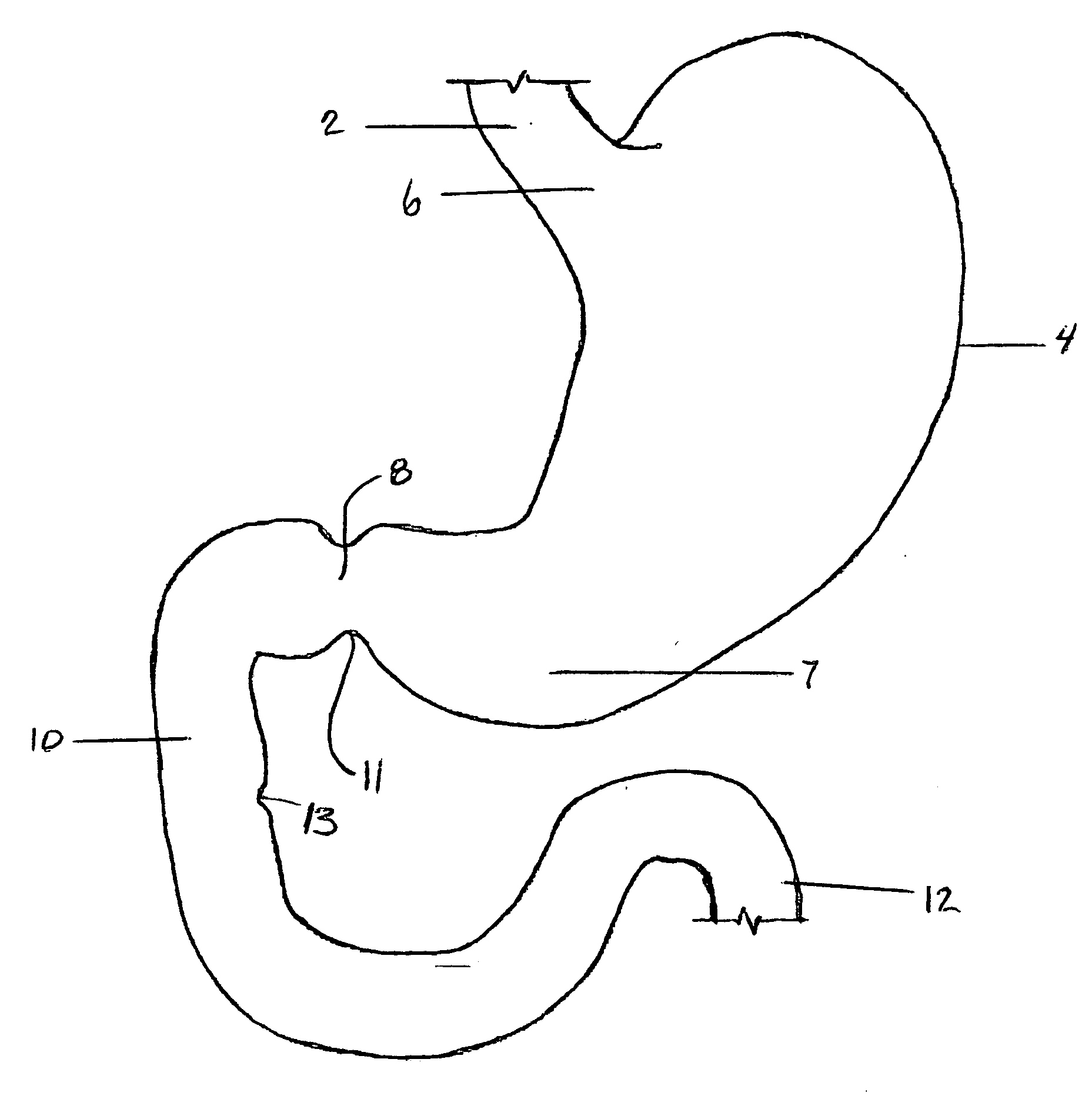 Method and apparatus for reducing obesity