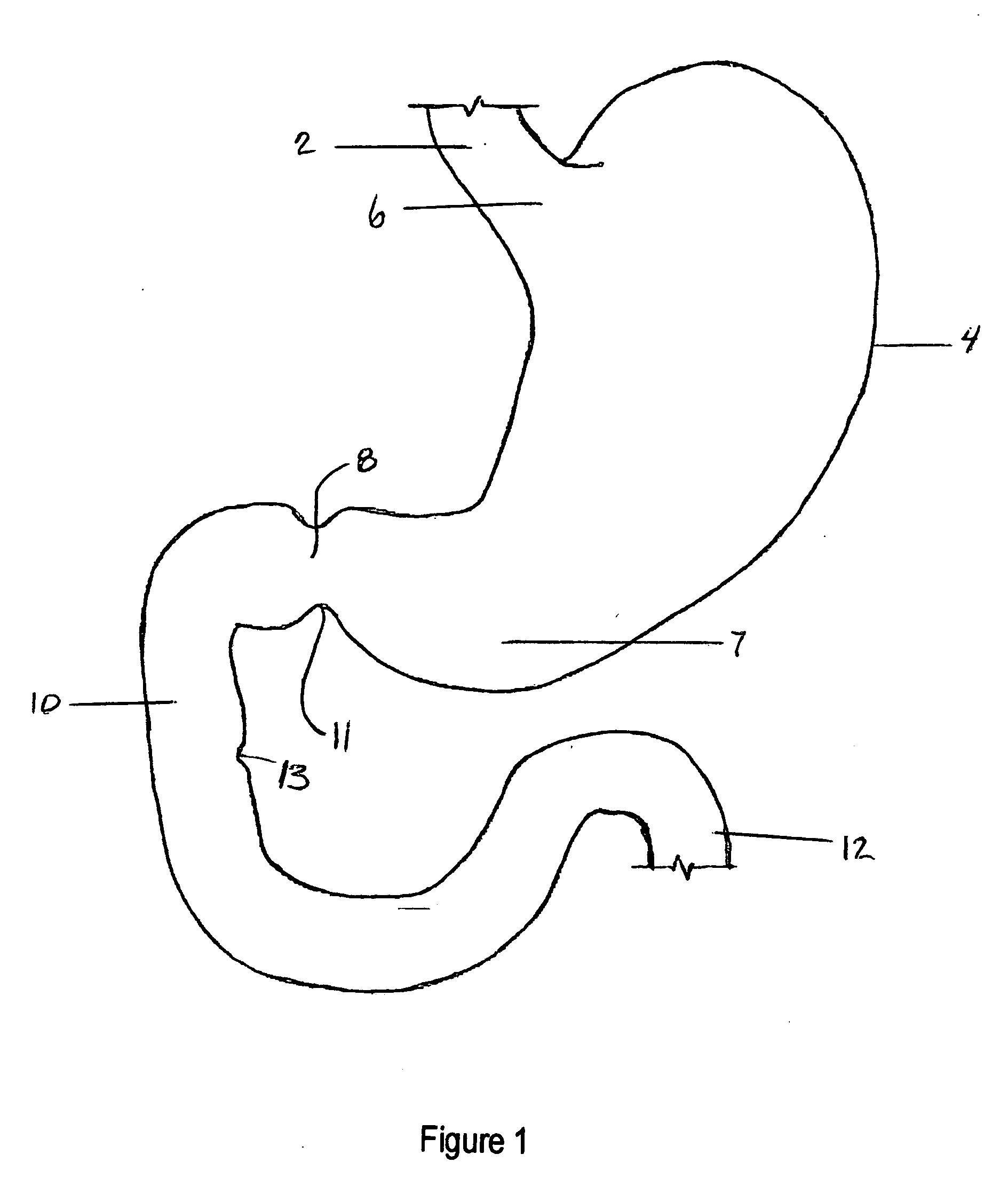 Method and apparatus for reducing obesity