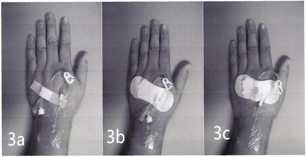 Y-shaped remaining needle catheter fixing device