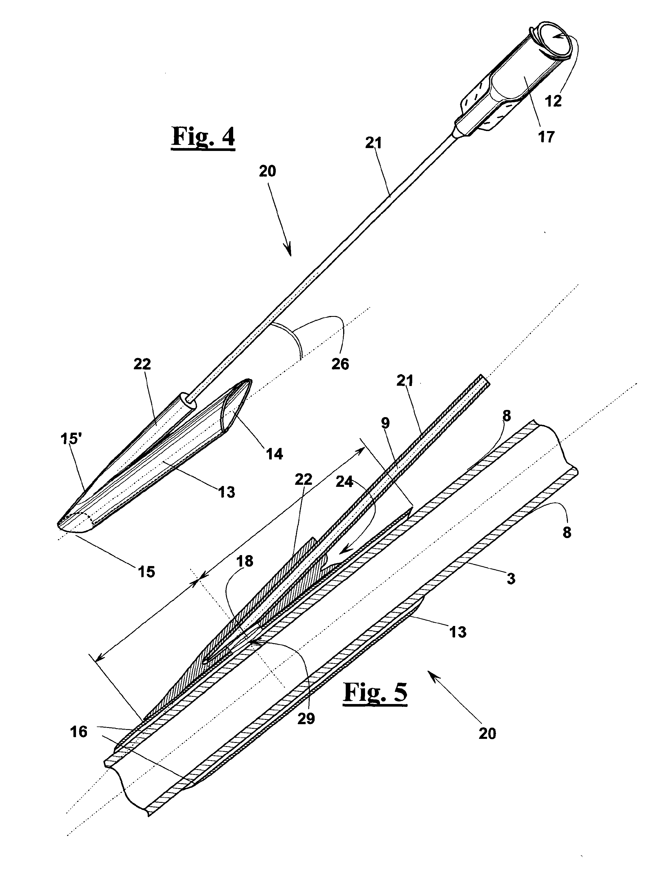 Occlusion device for vascular surgery