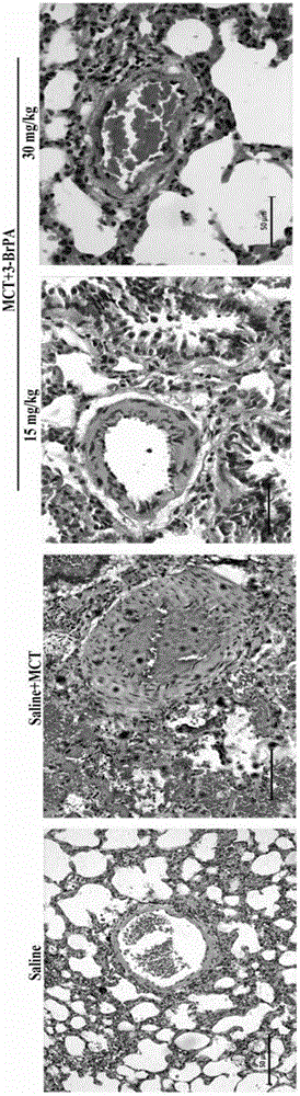 Application of 3-bromopyruvic acid in preparation of drug for treating pulmonary arterial hypertension