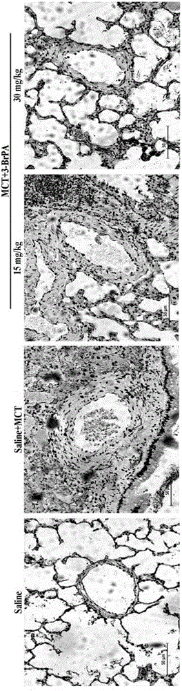 Application of 3-bromopyruvic acid in preparation of drug for treating pulmonary arterial hypertension