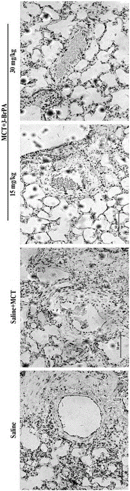 Application of 3-bromopyruvic acid in preparation of drug for treating pulmonary arterial hypertension