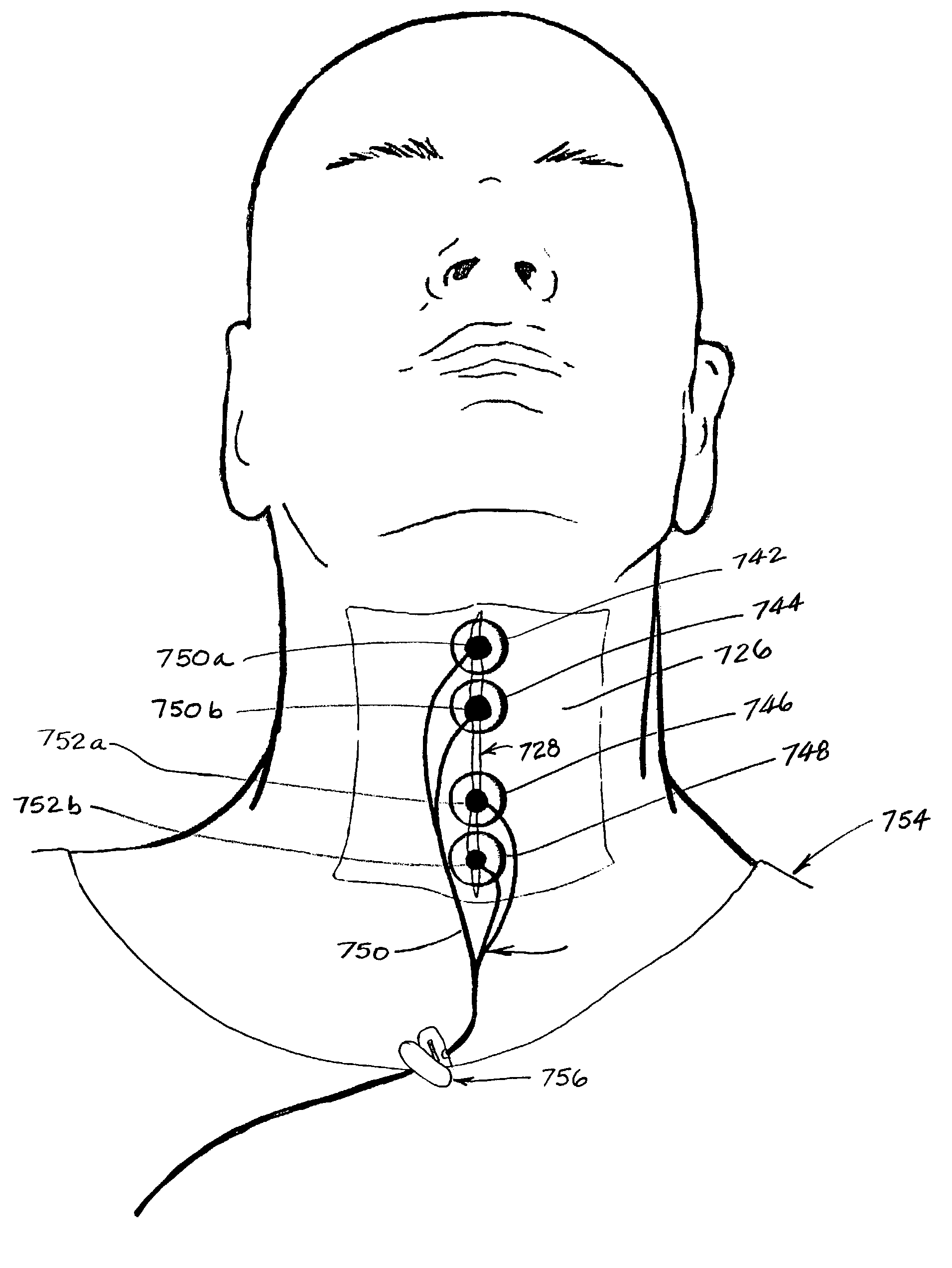 Method and apparatus for treating oropharyngeal disorders with electrical stimulation