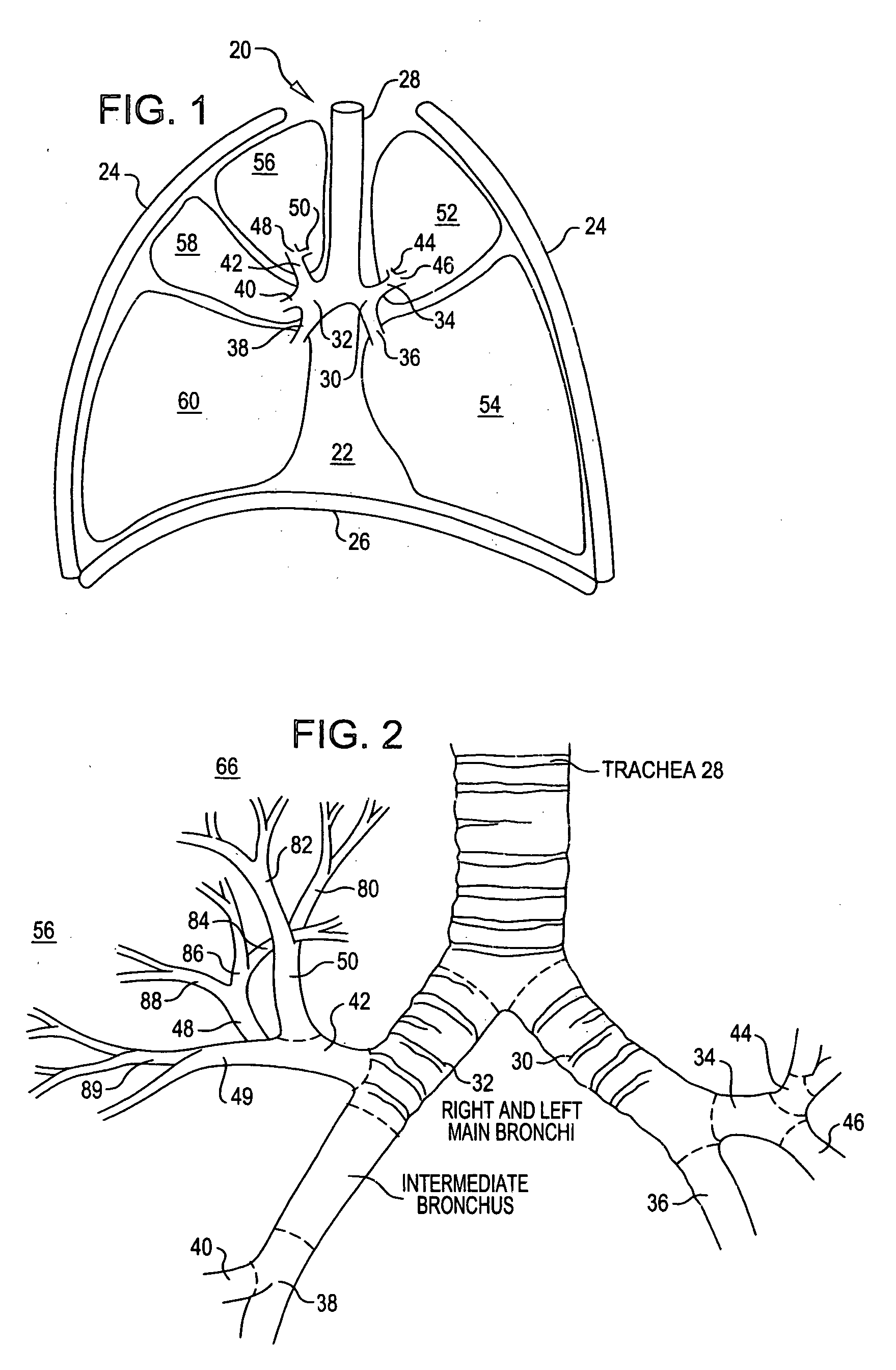 Device and method for intra-bronchial provision of a therapeutic agent