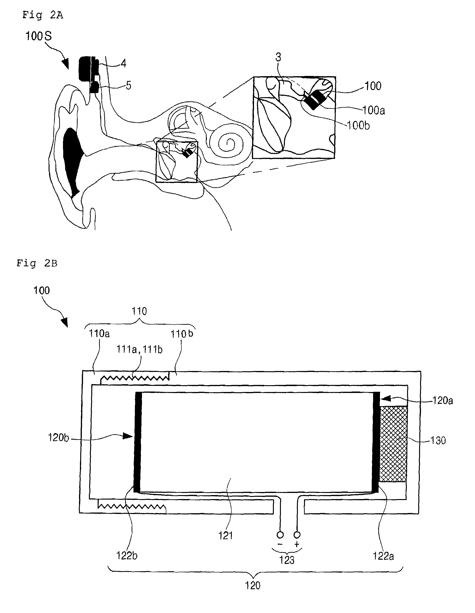 Piezoelectric type vibrator, implantable hearing aid with the same, and method of implanting the same