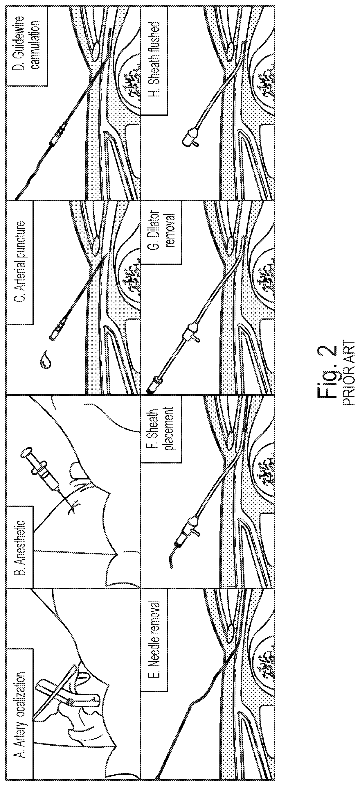 Device and method for automated emergency arterial sheath placement