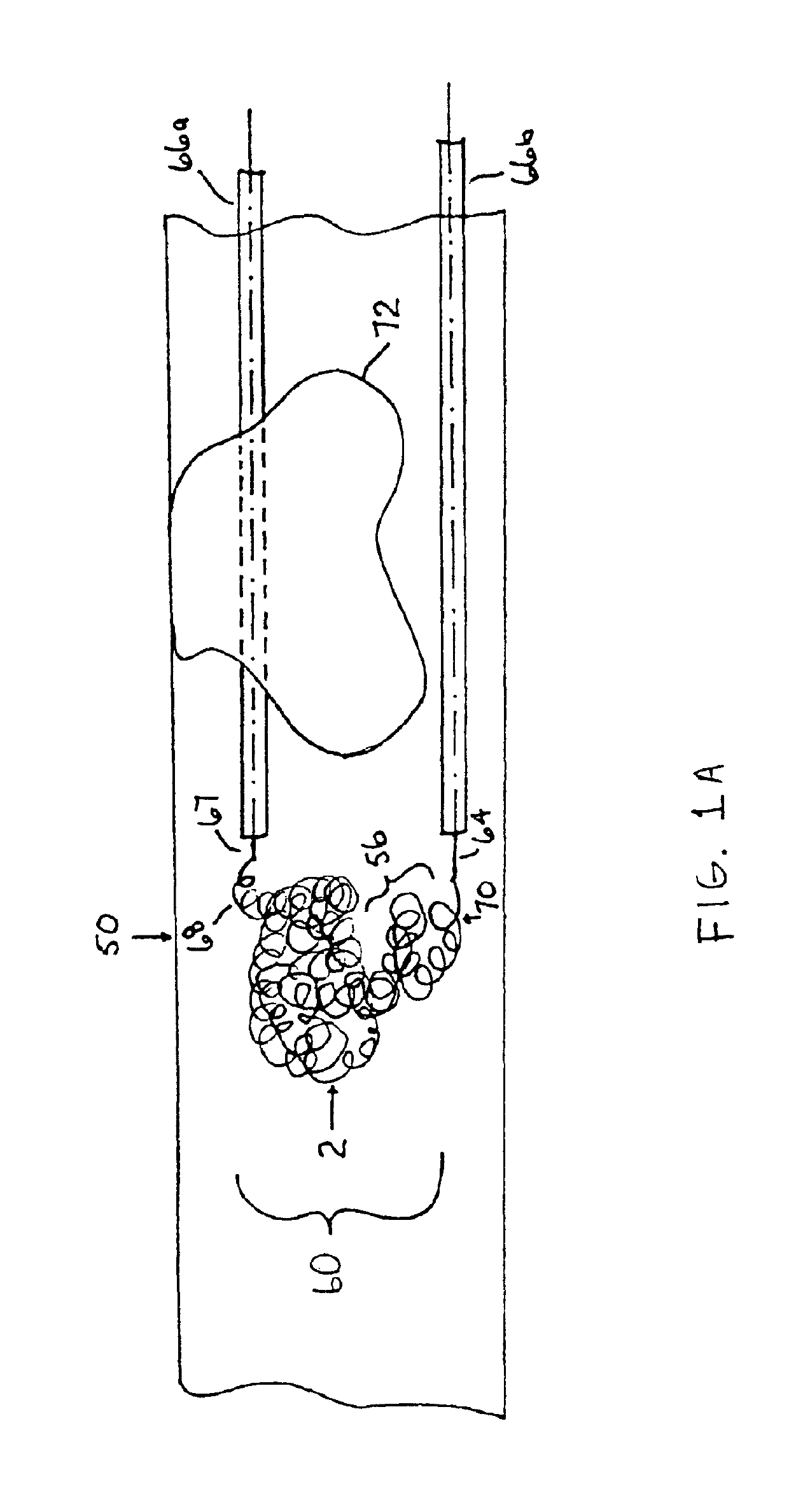 Thrombus removal system and process