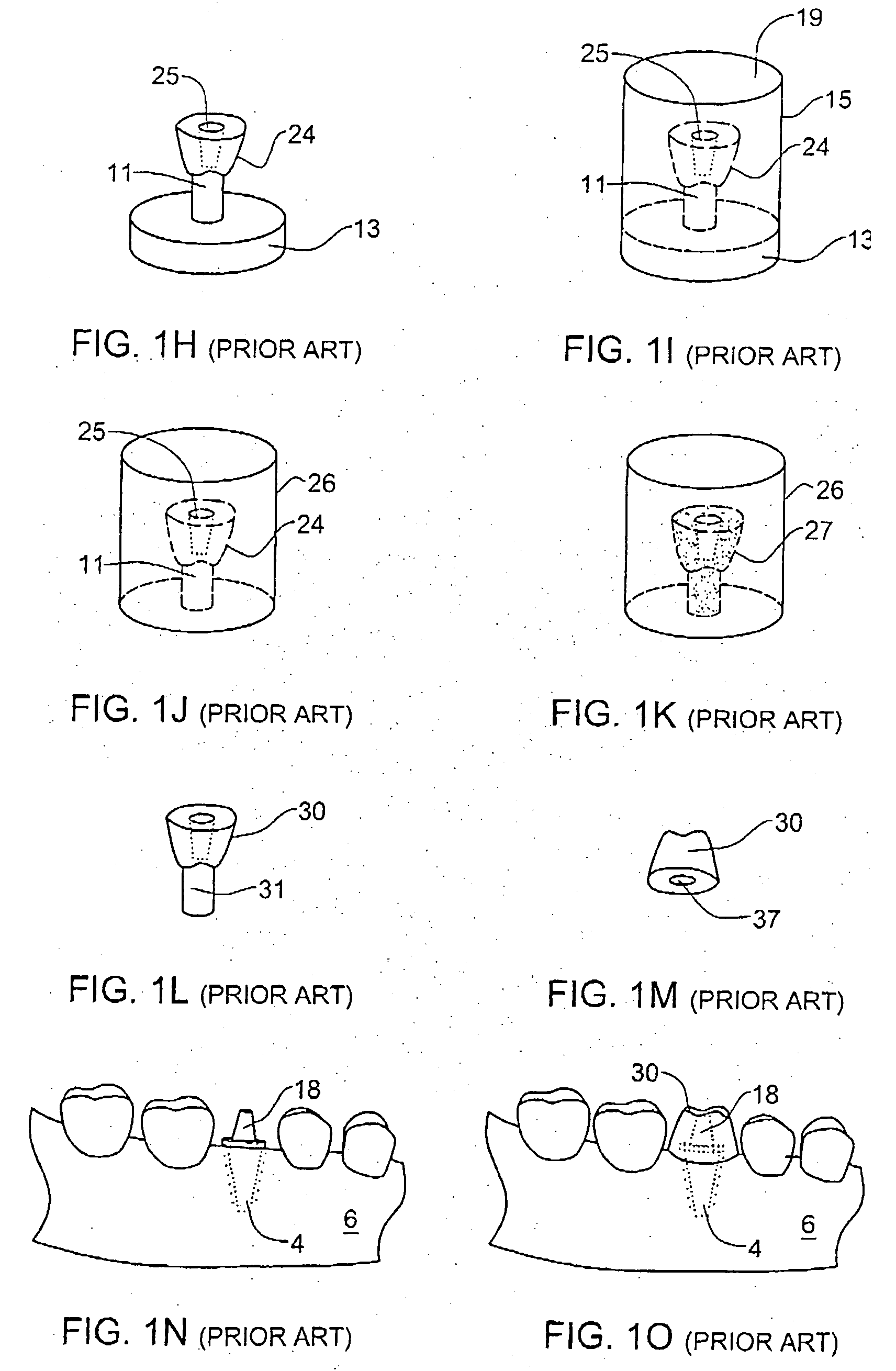 Method and accessory for preparing a dental crown or bridge
