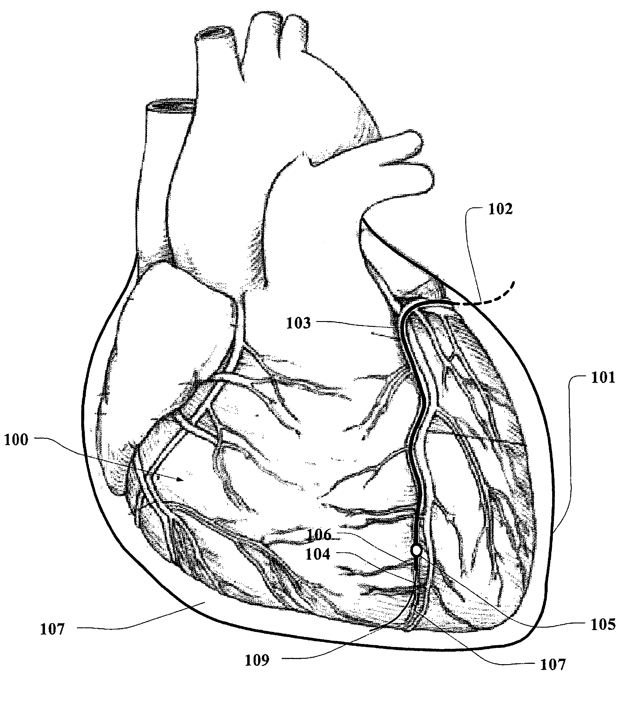 Method and device for accessing a pericardial space