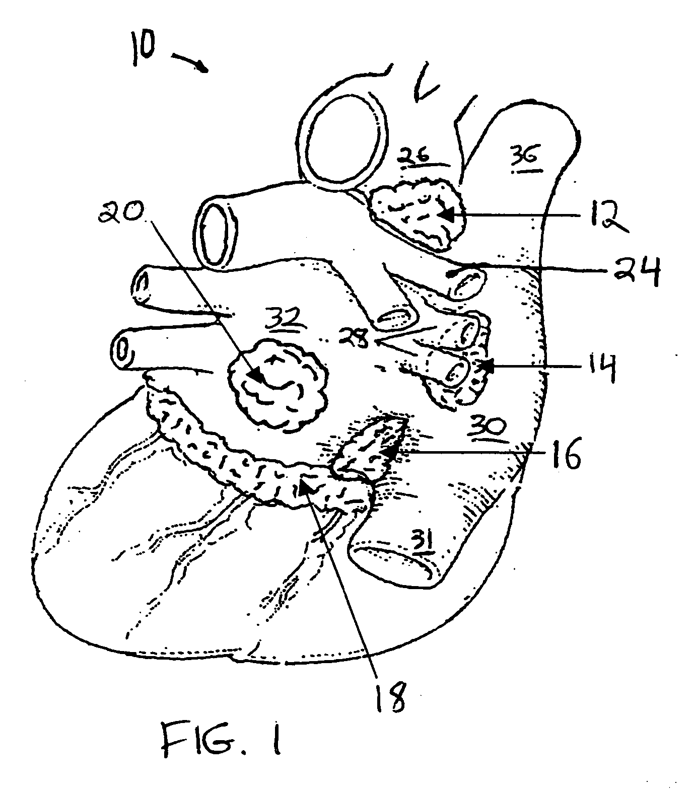 Systems and methods for selective denervation of heart dysrhythmias