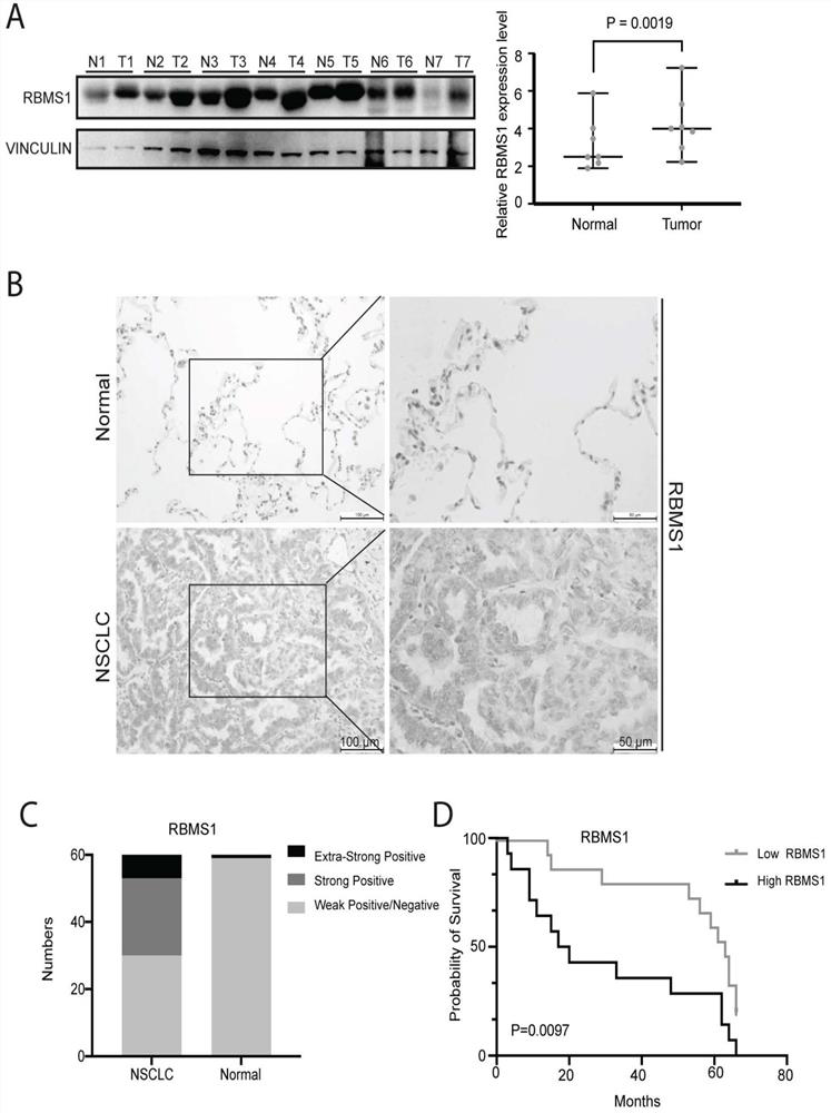 Application of reagent for down-regulating RBMS1 expression in preparation of medicine for treating lung cancer