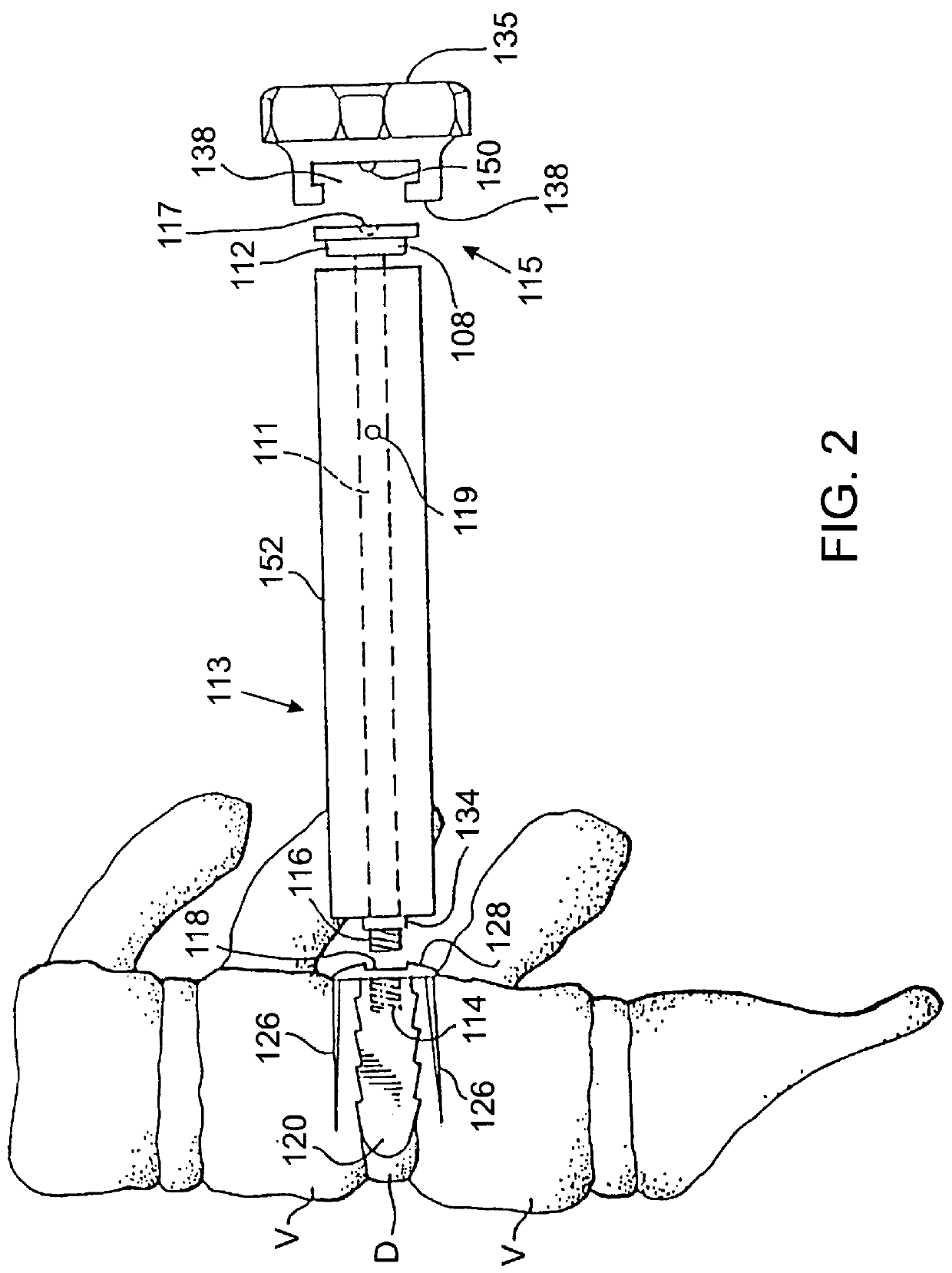 Method of inserting and preloading spinal implants