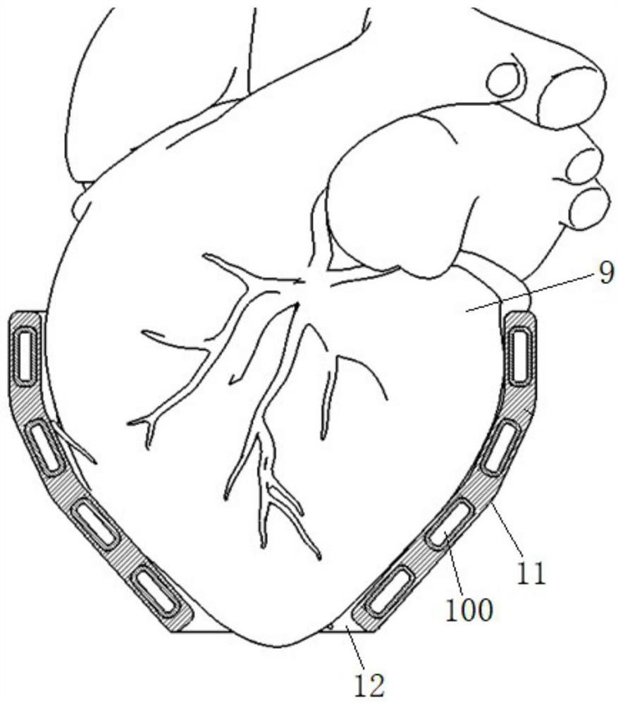 flexible ventricular assist device