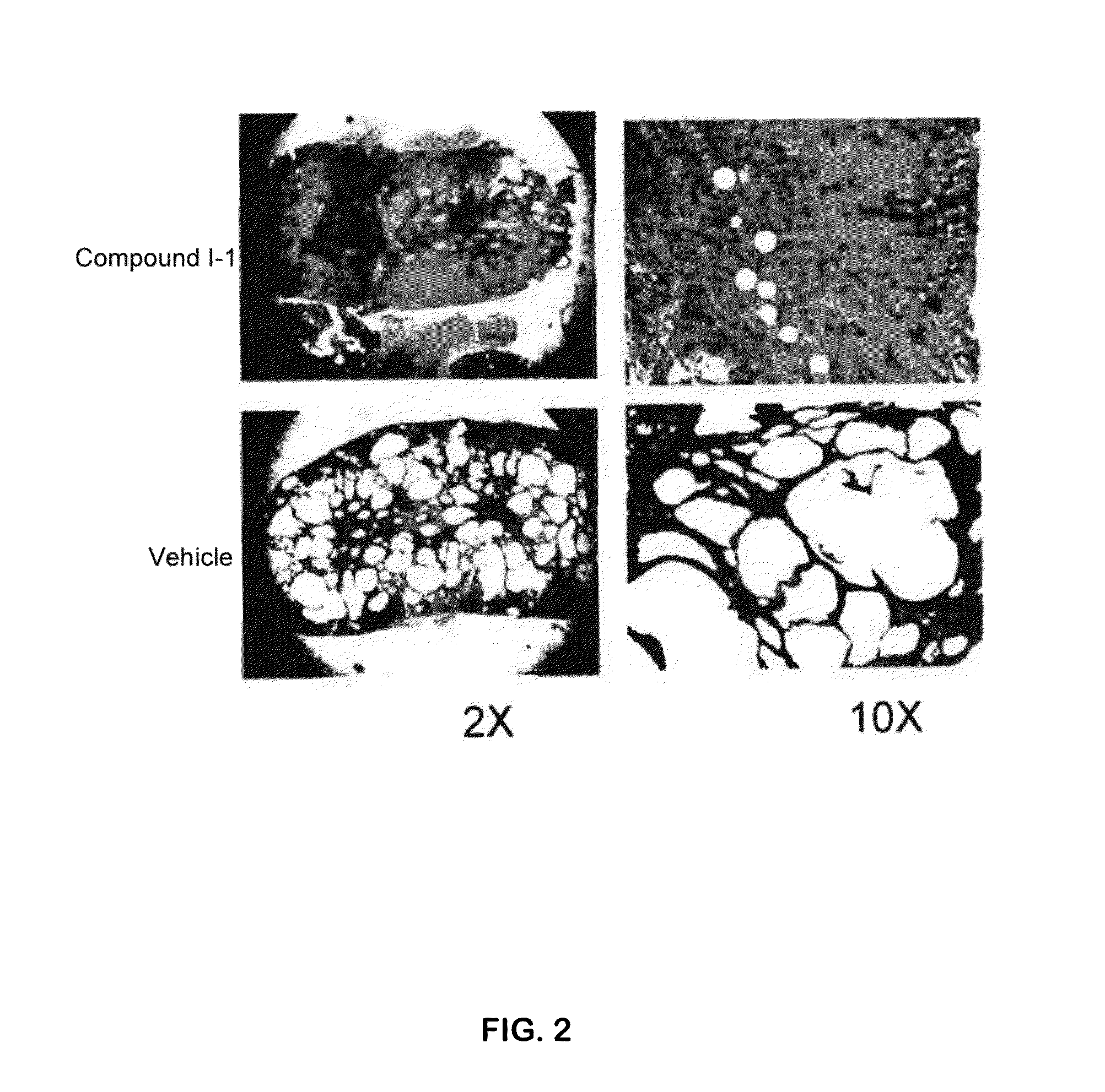 Methods for treating polycystic kidney disease and polycystic liver disease