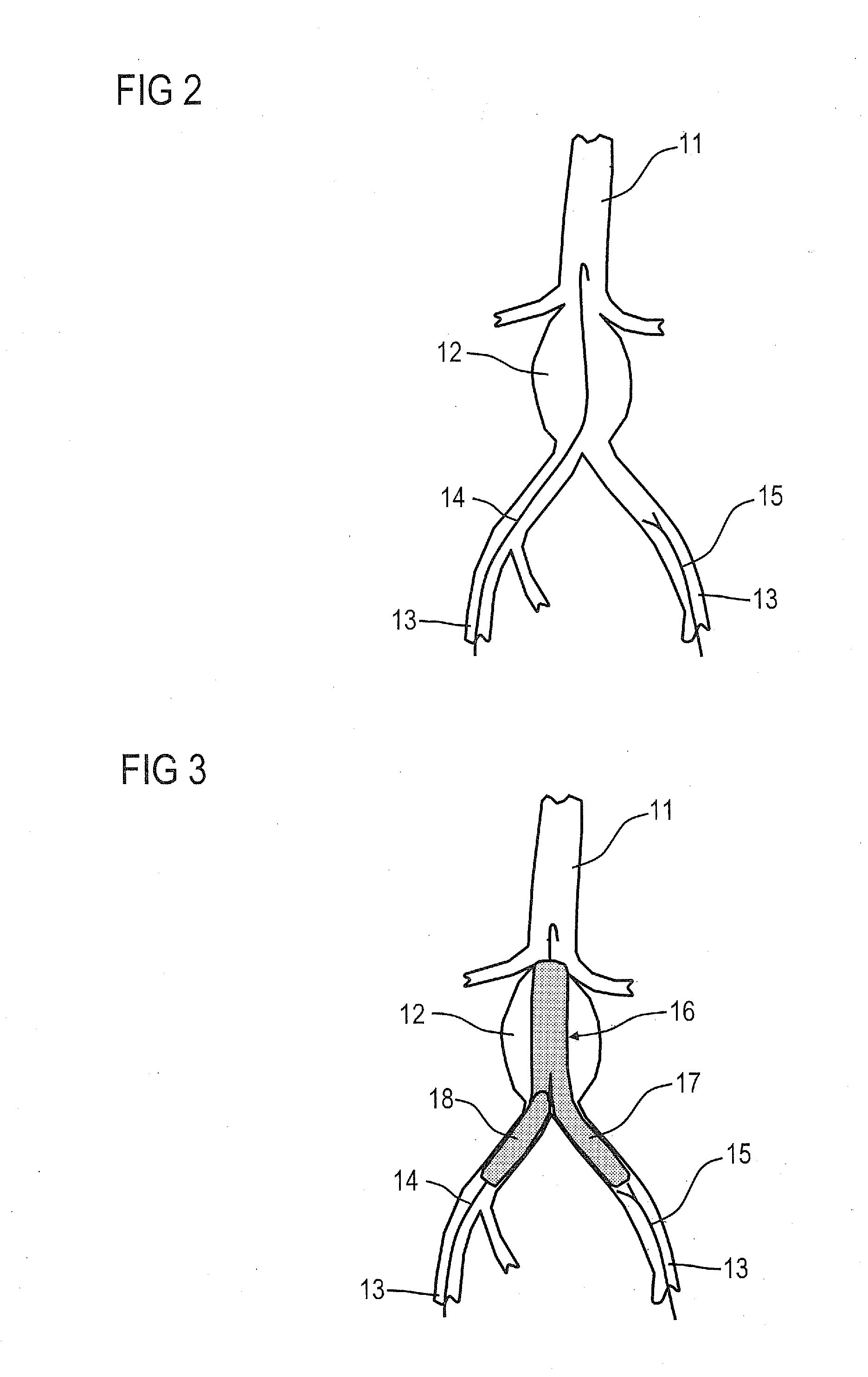 Angiography system for the angiographic examination of a patient and angiographic examination method