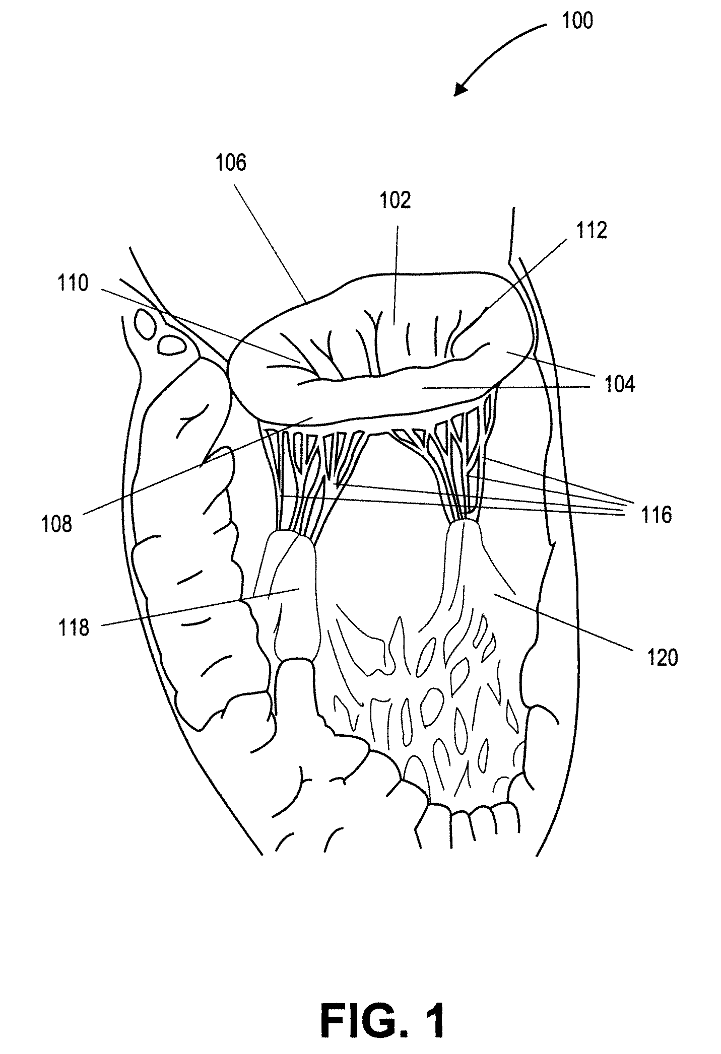 Heart valve prosthesis with collapsible valve and method of delivery thereof