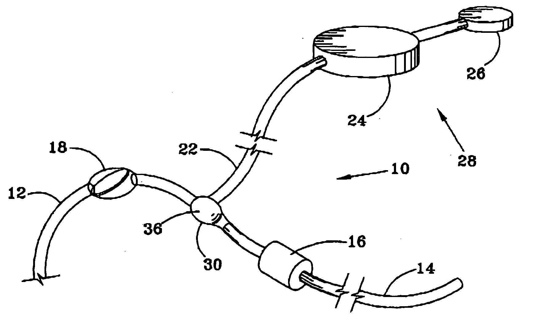 Implantable shunt system and method