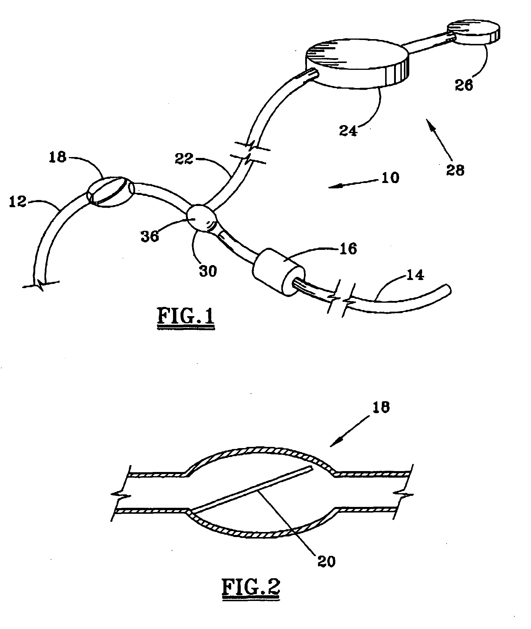 Implantable shunt system and method