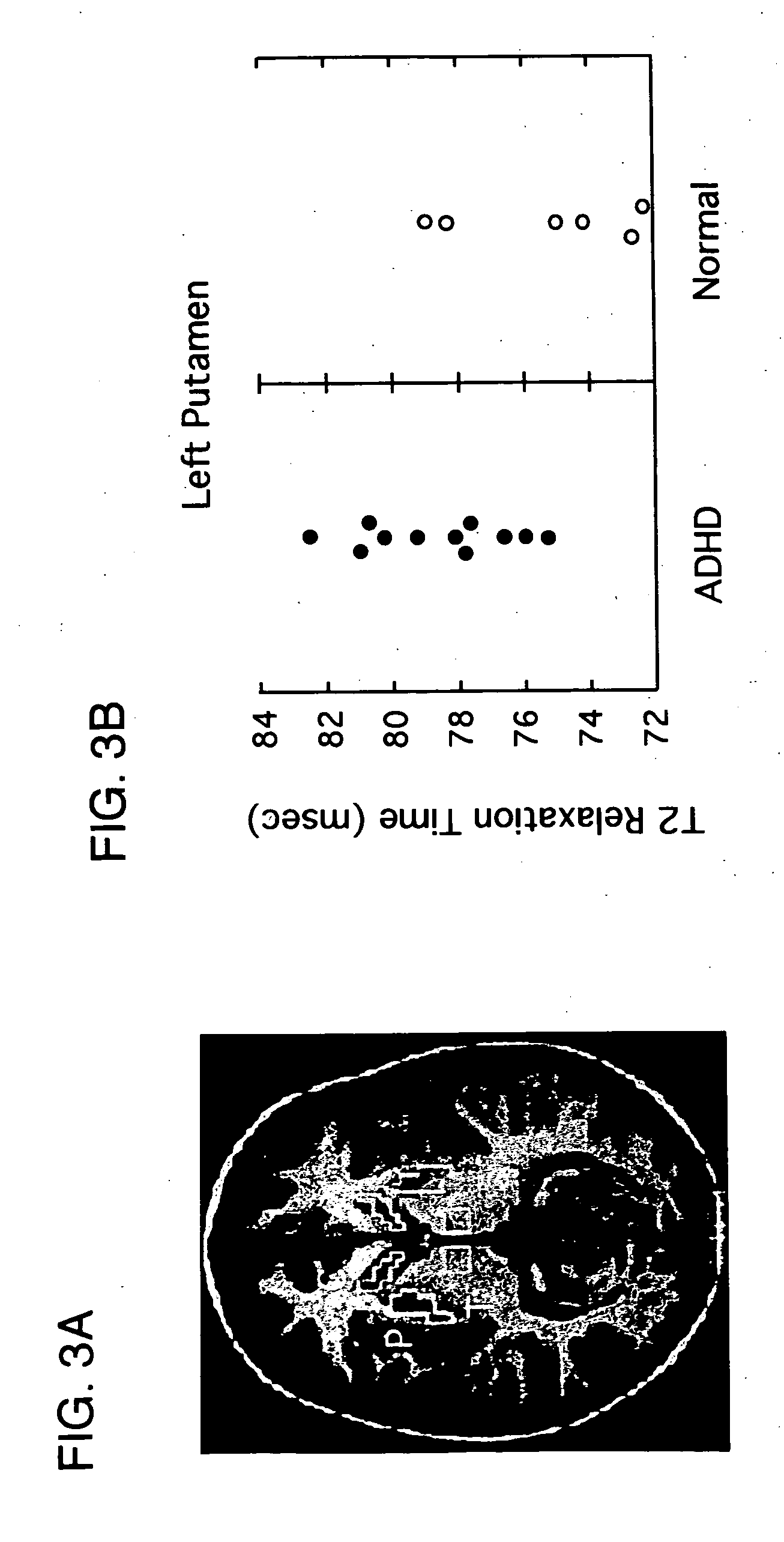 Methods of treating psychiatric substance abuse, and other disorders using combinations containing omega-3 fatty acids
