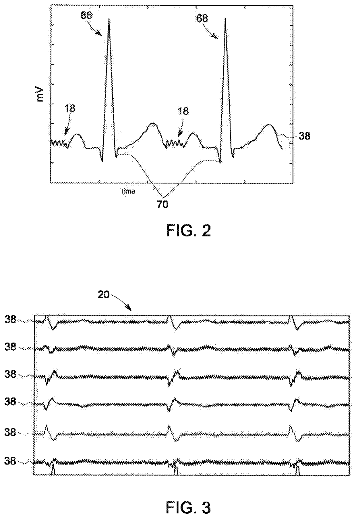System and method for analyzing noise in electrophysiology studies