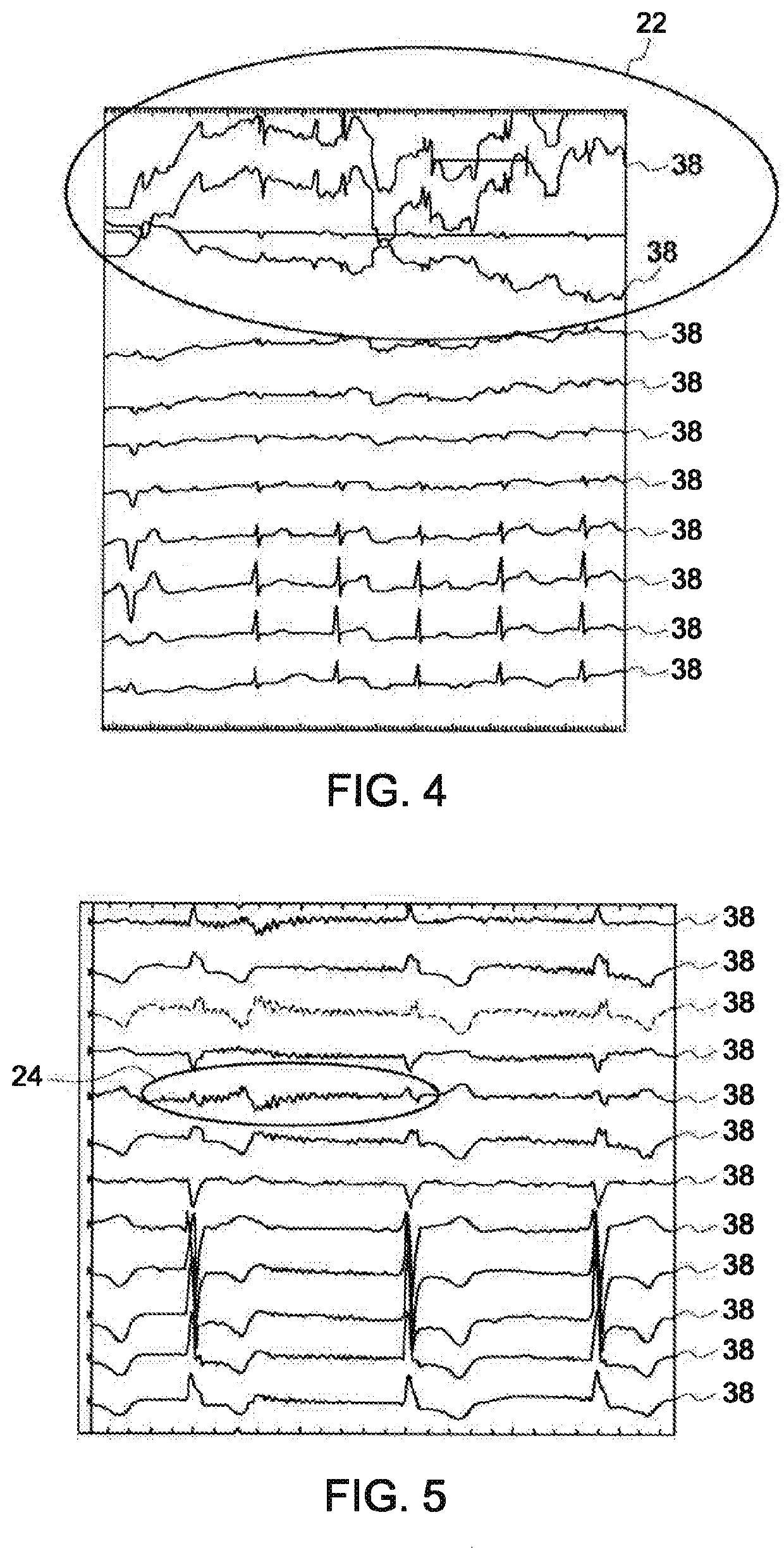 System and method for analyzing noise in electrophysiology studies