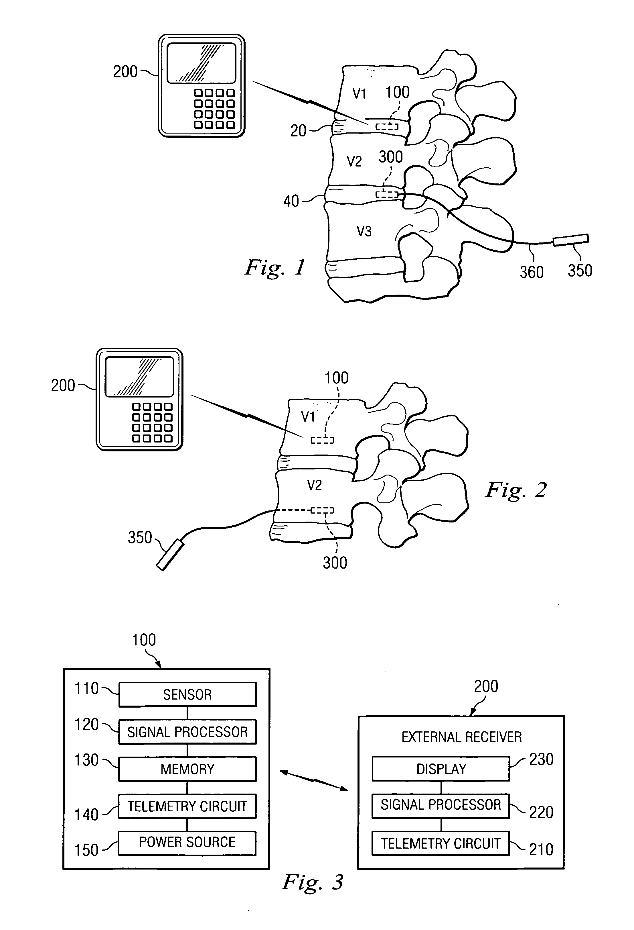 Sensor and method for spinal monitoring