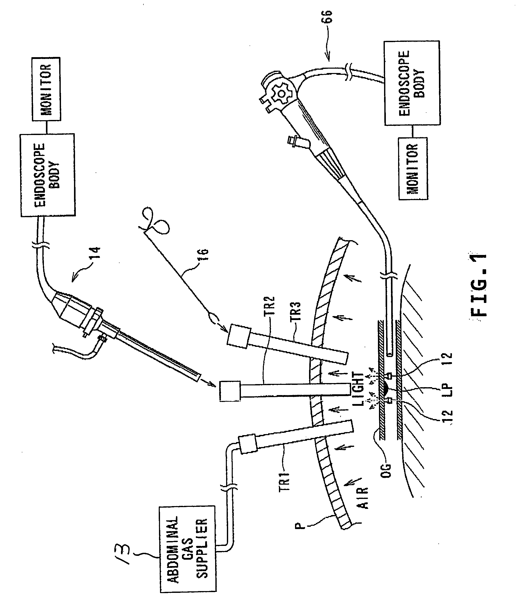 Lesion identification system for surgical operation and related method