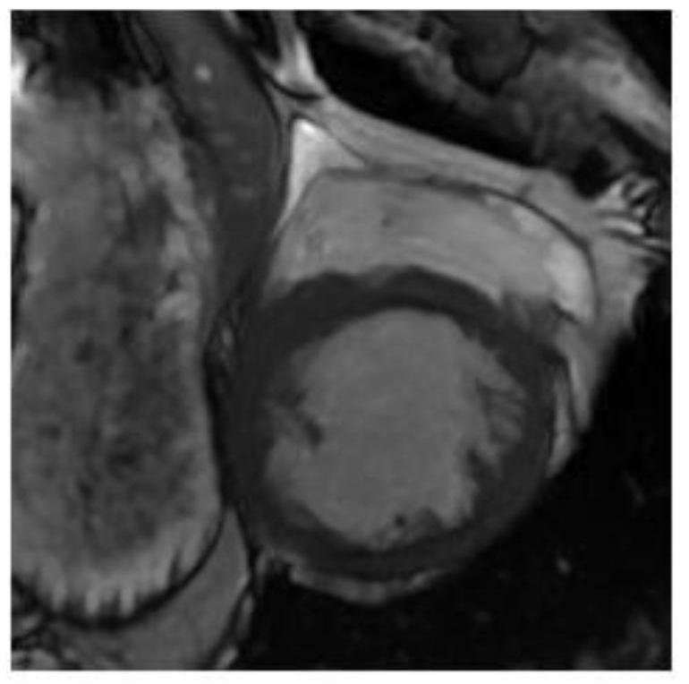 Segmentation method of blood pool in end-diastolic images of cardiac functional magnetic resonance images