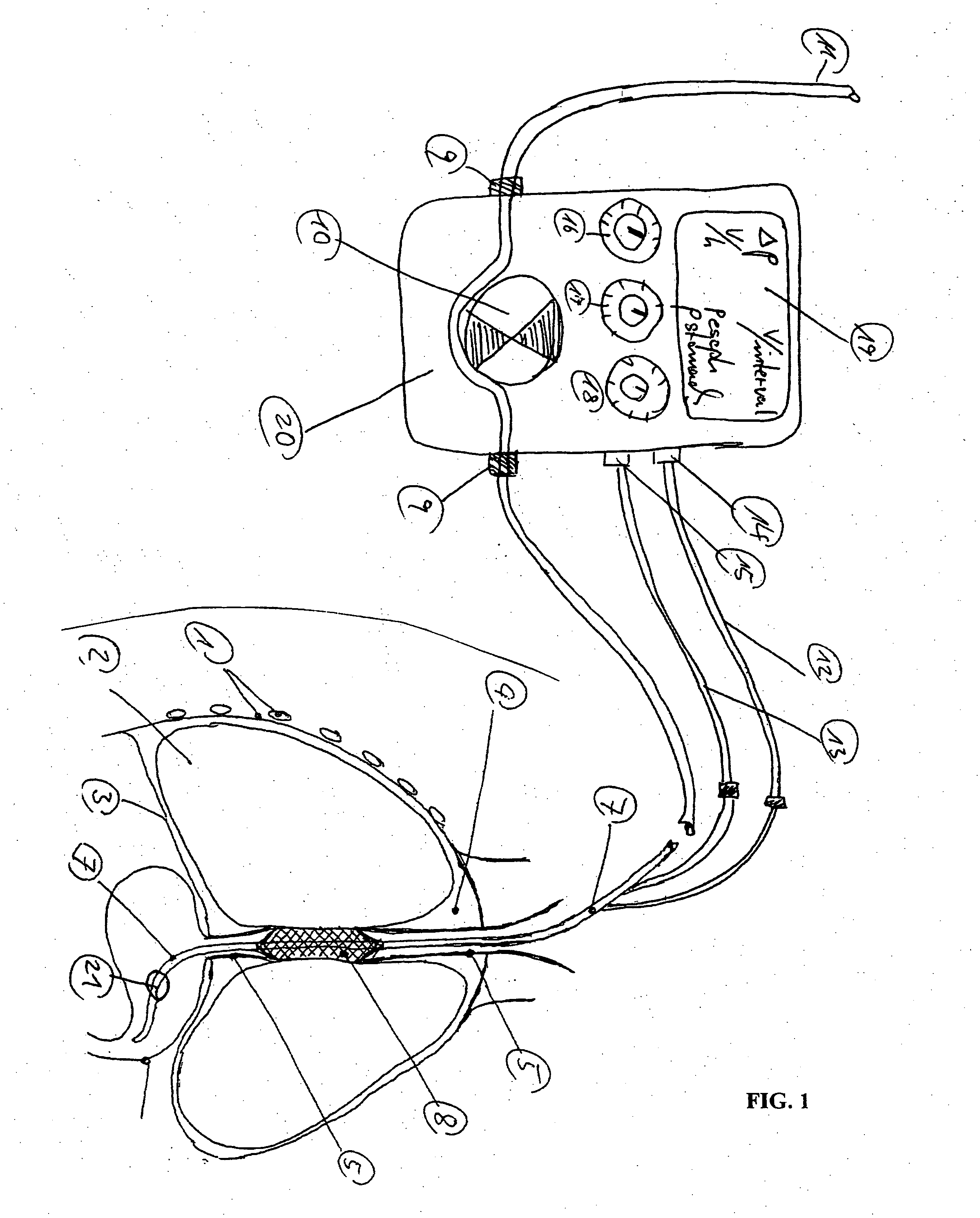 Gastro-esophageal reflux control system and pump
