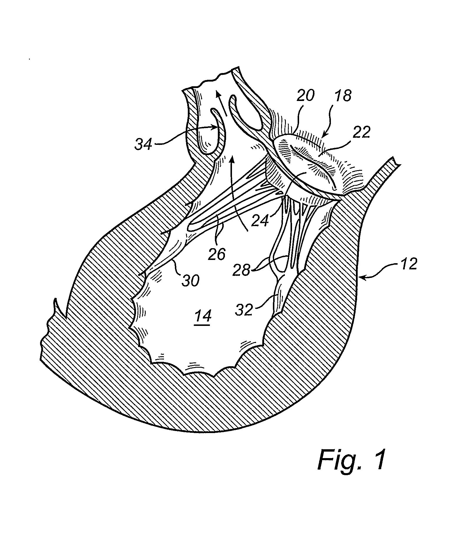Device and Method for Improving the Function of a Heart Valve