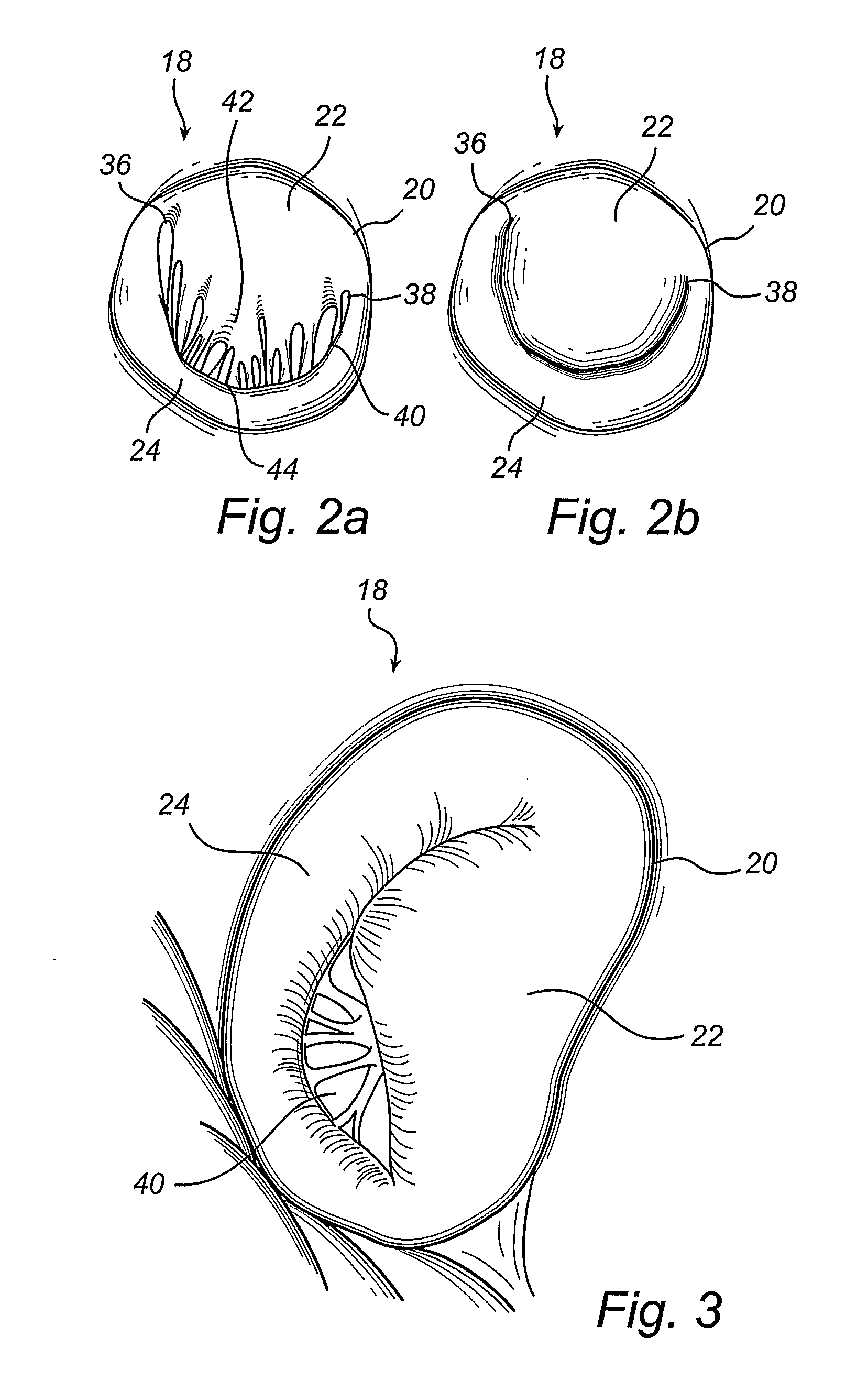Device and Method for Improving the Function of a Heart Valve