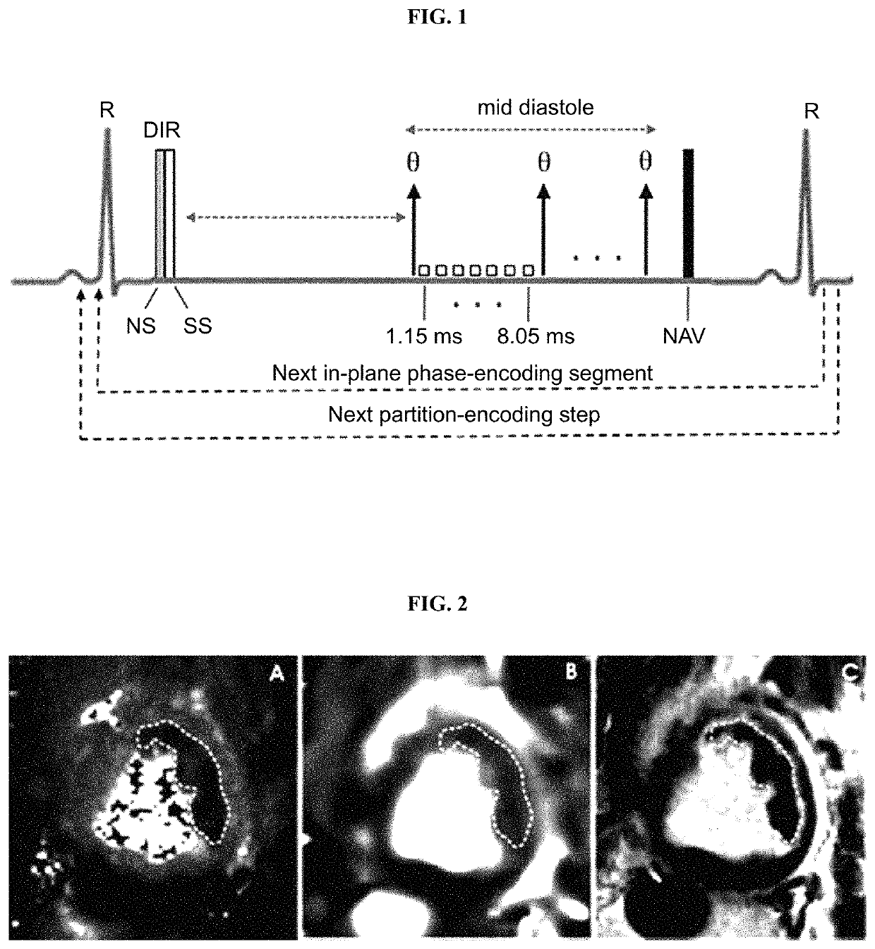 Assessment of iron deposition post myocardial infarction as a marker of myocardial hemorrhage