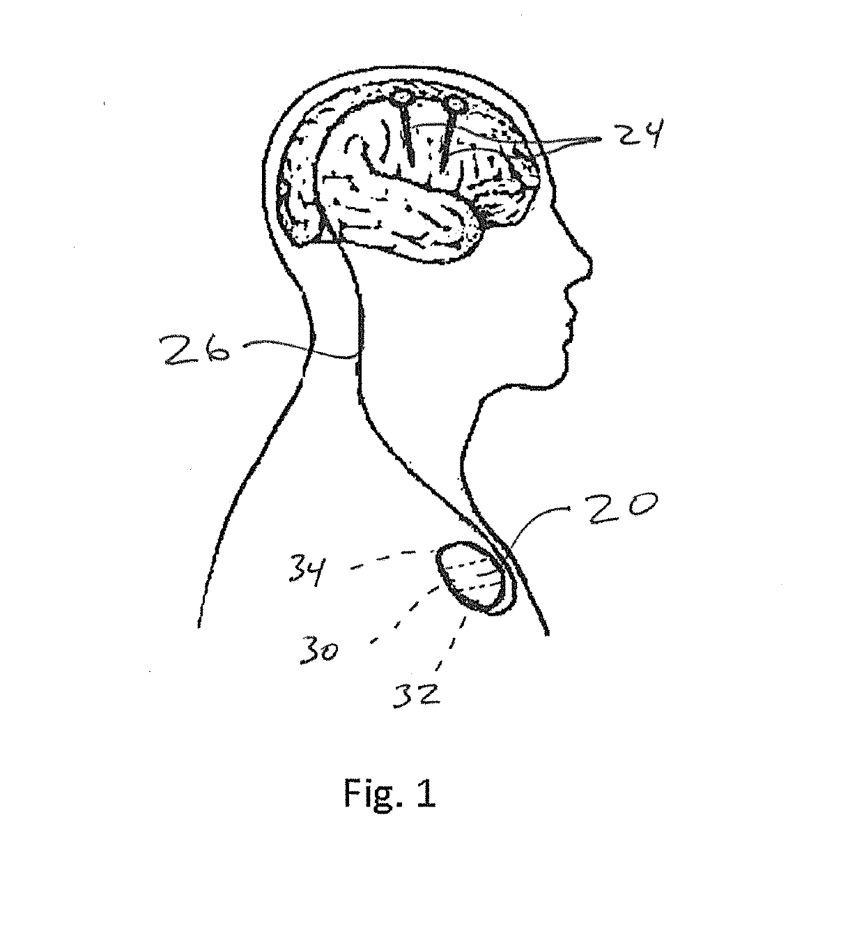 Method and apparatus for preventing or terminating epileptic seizures