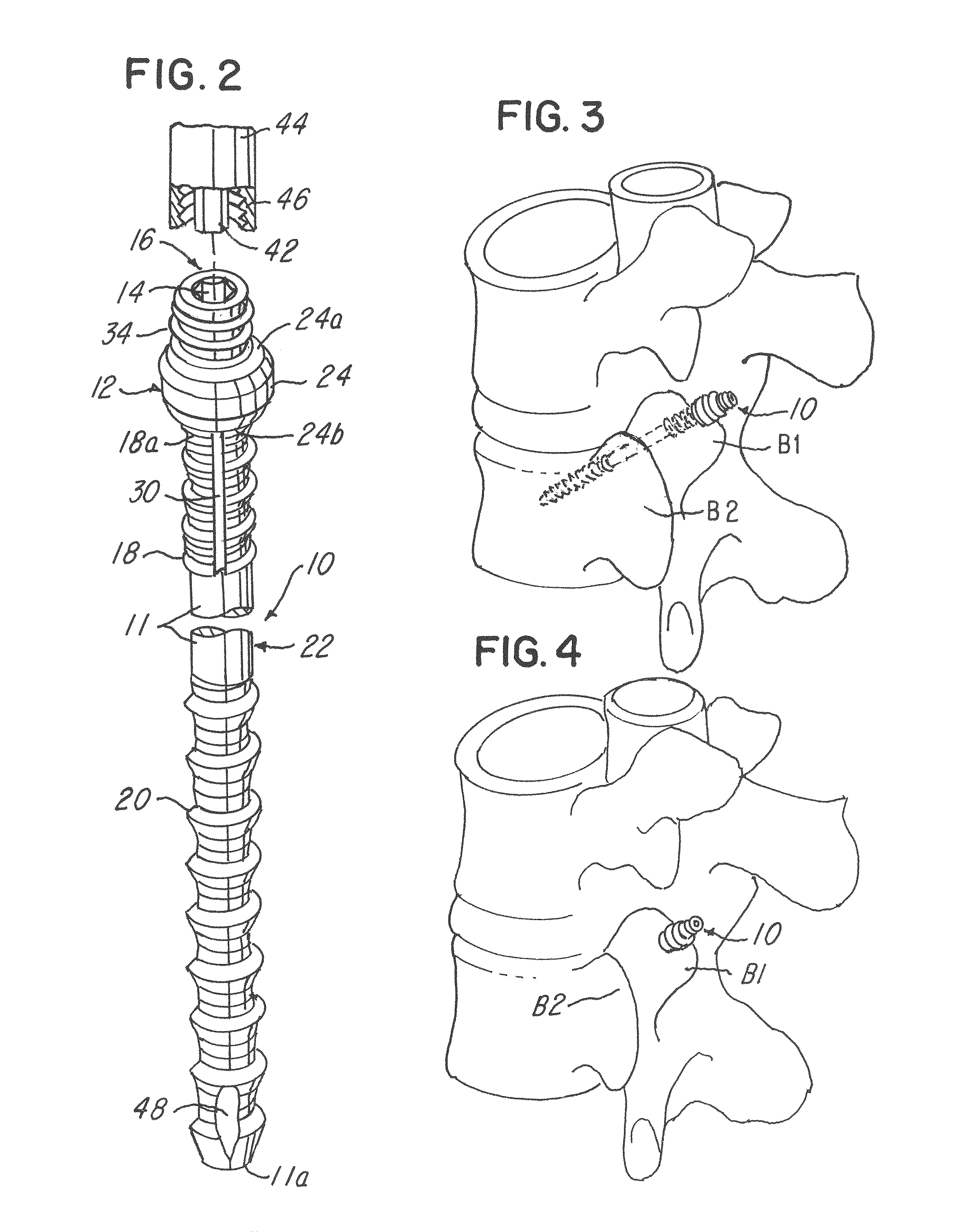 Minimally invasive spinal facet compression screw and system for bone joint fusion and fixation
